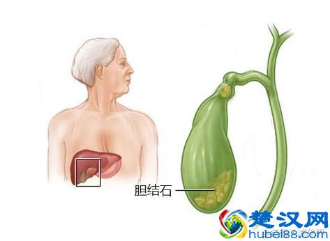 胆囊结石饮食禁忌：下面这些食物不能吃，否则病情加重