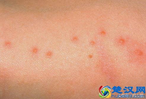 怎么消灭床上的可恶臭虫？