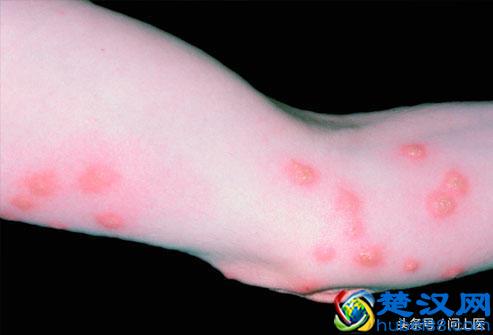 怎么消灭床上的可恶臭虫？