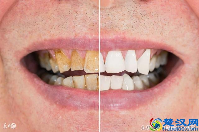 5个原因会让牙齿变黄，美白牙膏的原理是什么？让你秒懂