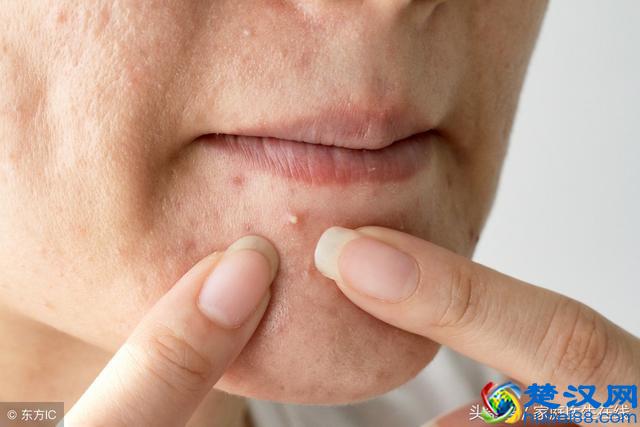 总是长痘痘怎么办？皮肤科专家来支招，这8个预防方法请收好