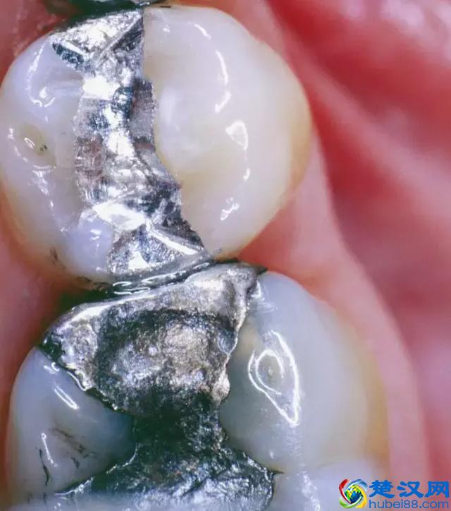 补牙用什么材料好？