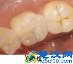 补牙用什么材料好？