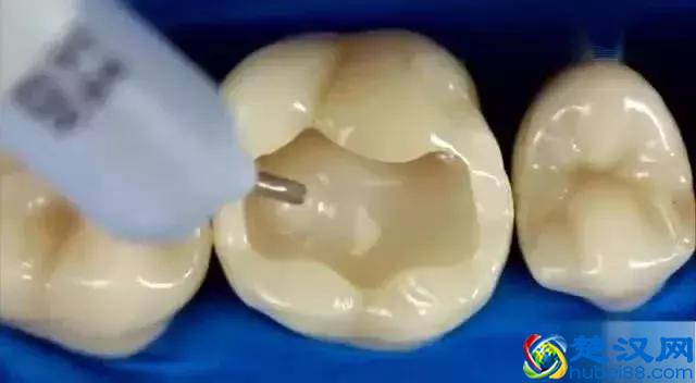 补牙用什么材料好？
