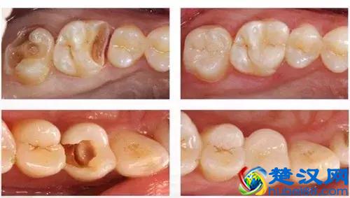 补牙用什么材料好？