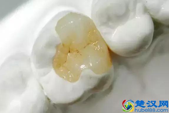 补牙用什么材料好？