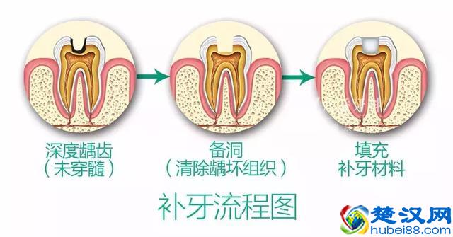 补牙用什么材料好？