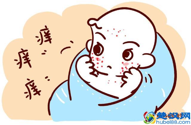 秋季天气干燥，宝宝得了湿疹怎么办？宝妈试试这四招