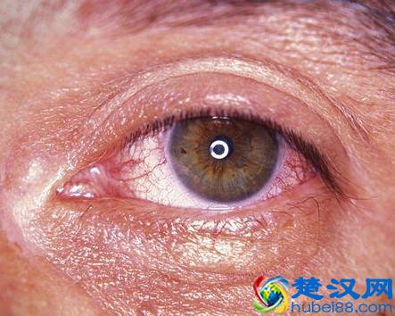 眼睛出现红血丝是怎么回事？教你几个实用小方法帮助眼睛赶走疲劳