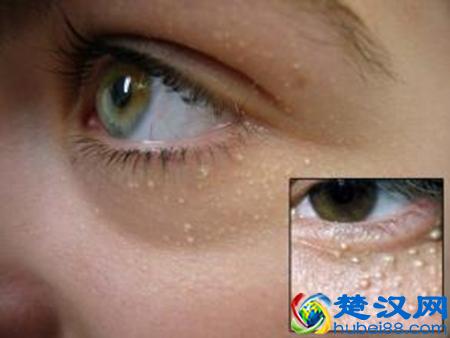 怎样去除眼部脂肪粒 三招妙招解除烦恼