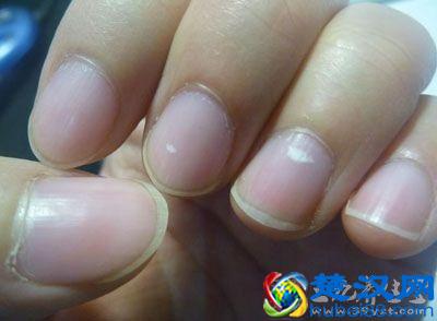 指甲上出现白点暗示健康亮“红灯”
