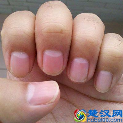 指甲上出现白点暗示健康亮“红灯”