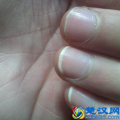 指甲上出现白点暗示健康亮“红灯”