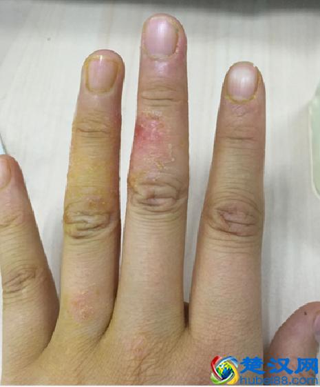 湿疹是怎么引起的？环境因素最重要