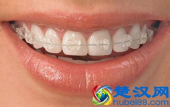 隐形牙齿矫正价格如何？贵不贵呢？