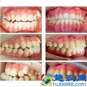隐形牙齿矫正价格如何？贵不贵呢？
