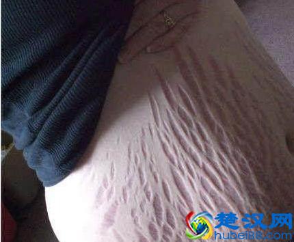 孕妇产后去除妊娠纹的5种方法，超管用！