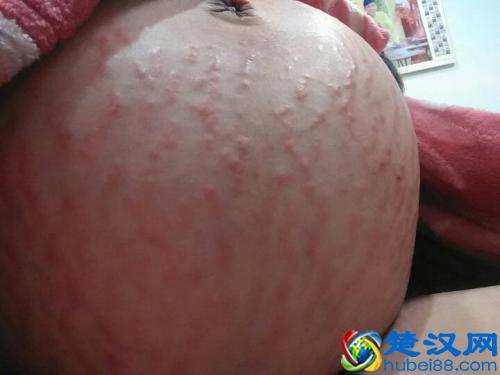 孕妇产后去除妊娠纹的5种方法，超管用！