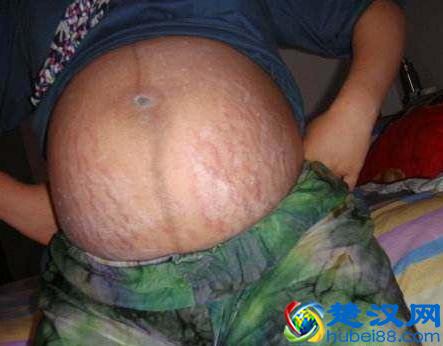 孕妇产后去除妊娠纹的5种方法，超管用！