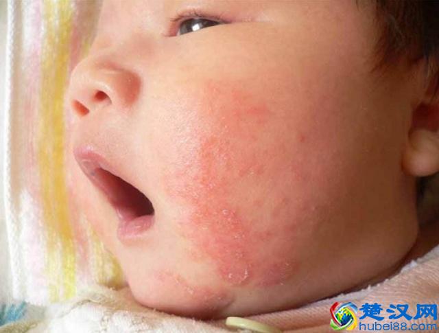 新生儿湿疹的原因及正确处理方法，建议新手父母收藏