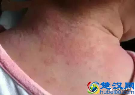 这些都不是婴儿湿疹（看图），妈妈们一定要记住！