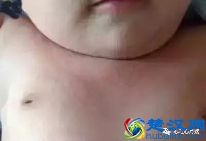 这些都不是婴儿湿疹（看图），妈妈们一定要记住！