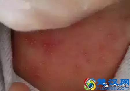 这些都不是婴儿湿疹（看图），妈妈们一定要记住！