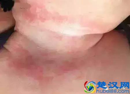 这些都不是婴儿湿疹（看图），妈妈们一定要记住！