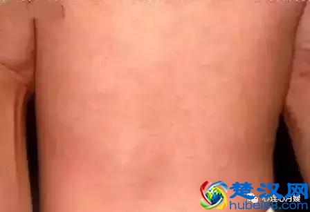 这些都不是婴儿湿疹（看图），妈妈们一定要记住！