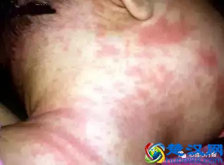 这些都不是婴儿湿疹（看图），妈妈们一定要记住！