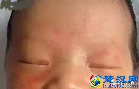 这些都不是婴儿湿疹（看图），妈妈们一定要记住！