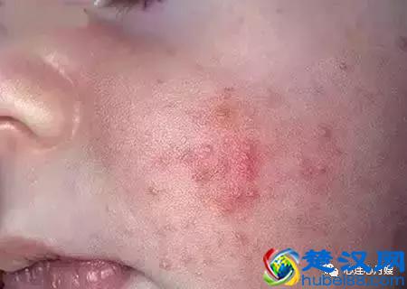 这些都不是婴儿湿疹（看图），妈妈们一定要记住！