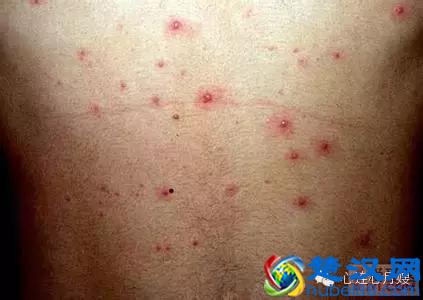 这些都不是婴儿湿疹（看图），妈妈们一定要记住！