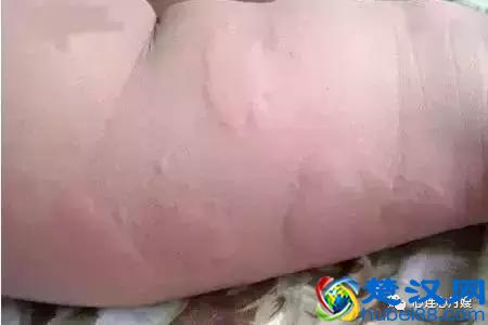 这些都不是婴儿湿疹（看图），妈妈们一定要记住！