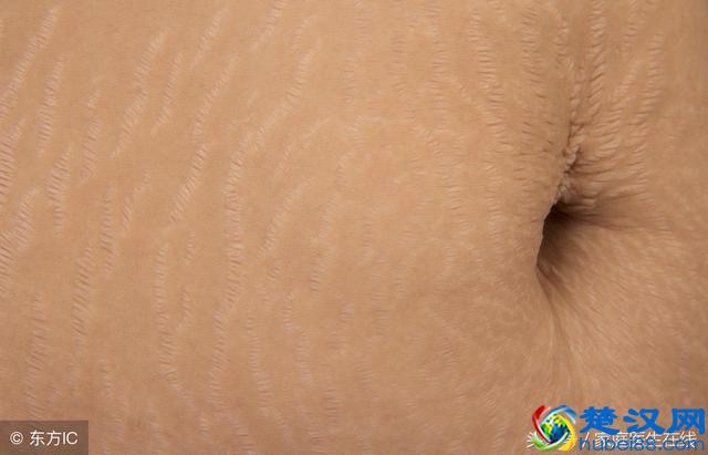 妊娠纹怎么消除？推荐4个好方法，试了不亏！