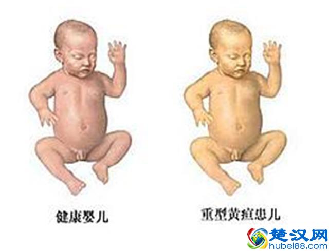 新生儿黄疸正常值是多少？新生儿黄疸怎么办呢？