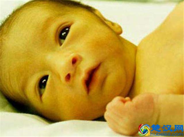 新生儿黄疸正常值是多少？新生儿黄疸怎么办呢？