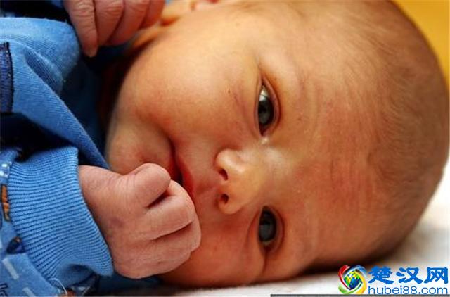 新生儿黄疸正常值是多少？新生儿黄疸怎么办呢？