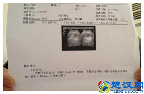 吃打胎药后以为已经流产，五个月后检查看到胎儿手足无措