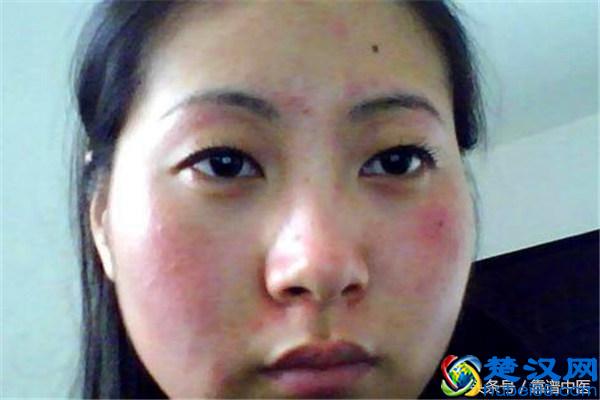 脸过敏发红痒怎么办？避免这些告别过敏体质