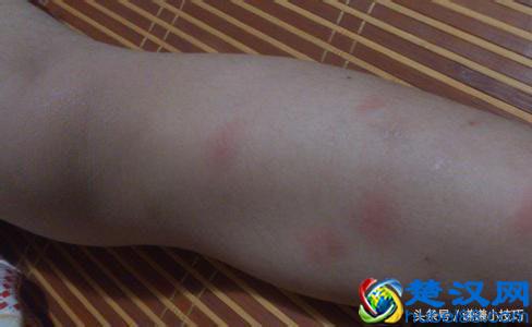 很多人不知道蚊子怕什么，教你几招对付蚊子，杠杠的