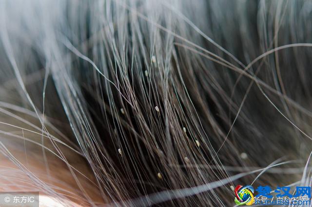 70/80后小时候爱长的虱子，你知道怎么根除吗？