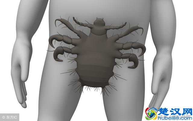 70/80后小时候爱长的虱子，你知道怎么根除吗？