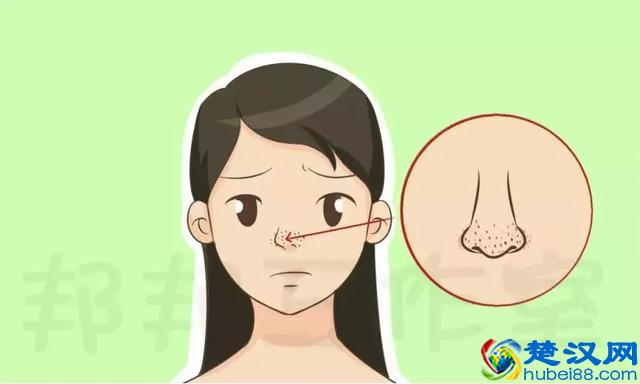 白头、黑头粉刺此起彼伏，皮肤科专家教你怎样才能去除？