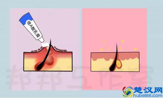 白头、黑头粉刺此起彼伏，皮肤科专家教你怎样才能去除？