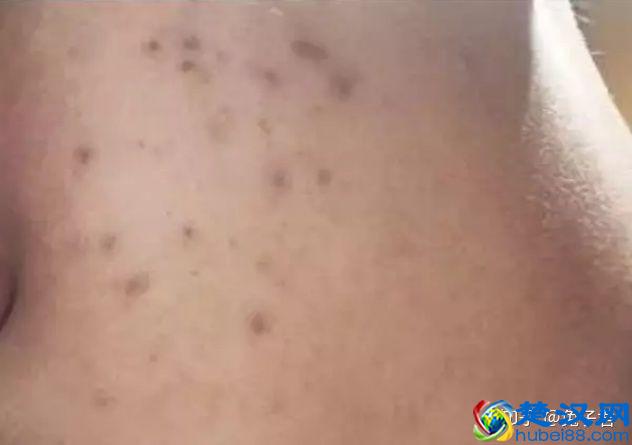 脸上痘印总不掉？教你3步祛除痘印！