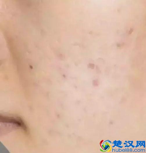 脸上痘印总不掉？教你3步祛除痘印！