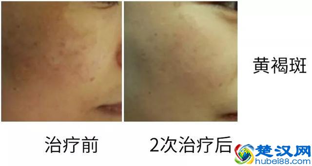 果酸换肤！每次治疗不到10分钟，让你的皮肤焕然一新