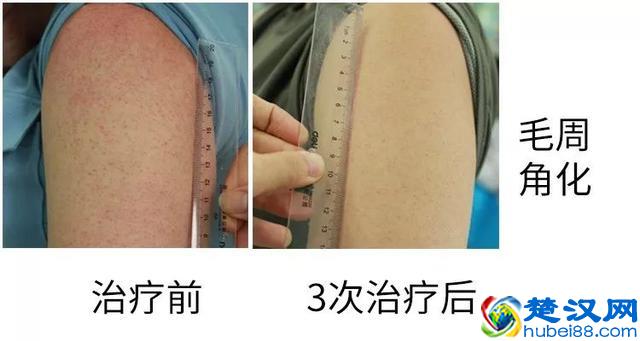 果酸换肤！每次治疗不到10分钟，让你的皮肤焕然一新