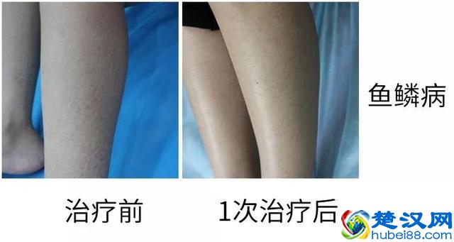 果酸换肤！每次治疗不到10分钟，让你的皮肤焕然一新